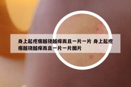 身上起疙瘩越挠越痒而且一片一片 身上起疙瘩越挠越痒而且一片一片图片