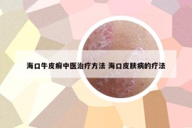 海口牛皮癣中医治疗方法 海口皮肤病的疗法