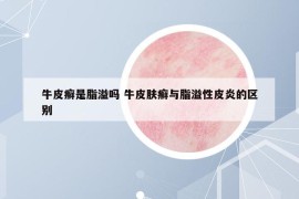 牛皮癣是脂溢吗 牛皮肤癣与脂溢性皮炎的区别