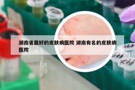 湖南省最好的皮肤病医院 湖南有名的皮肤病医院