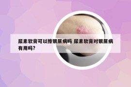 尿素软膏可以擦银屑病吗 尿素软膏对银屑病有用吗?