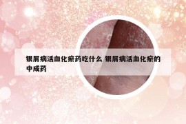 银屑病活血化瘀药吃什么 银屑病活血化瘀的中成药
