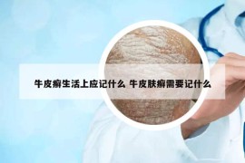 牛皮癣生活上应记什么 牛皮肤癣需要记什么