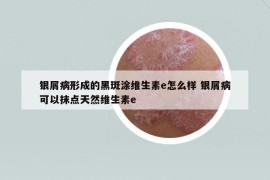 银屑病形成的黑斑涂维生素e怎么样 银屑病可以抹点天然维生素e