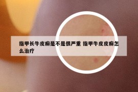 指甲长牛皮癣是不是很严重 指甲牛皮皮癣怎么治疗