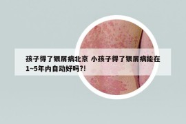 孩子得了银屑病北京 小孩子得了银屑病能在1~5年内自动好吗?!