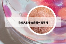 白癜风和牛皮癣是一回事吗