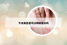 牛皮癣患者可以喝蜂蜜水吗