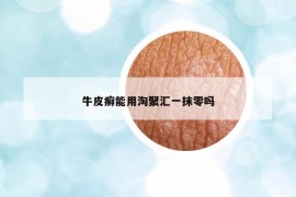 牛皮癣能用淘聚汇一抹零吗