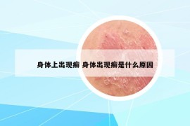 身体上出现癣 身体出现癣是什么原因