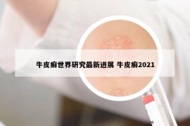 牛皮癣世界研究最新进展 牛皮癣2021