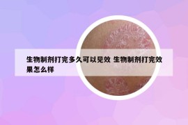 生物制剂打完多久可以见效 生物制剂打完效果怎么样