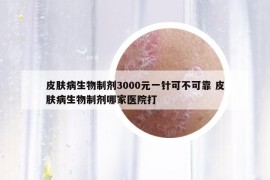 皮肤病生物制剂3000元一针可不可靠 皮肤病生物制剂哪家医院打