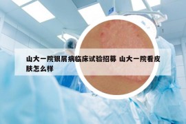 山大一院银屑病临床试验招募 山大一院看皮肤怎么样