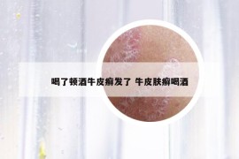 喝了顿酒牛皮癣发了 牛皮肤癣喝酒