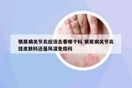 银屑病关节炎应该去看哪个科 银屑病关节炎挂皮肤科还是风湿免疫科
