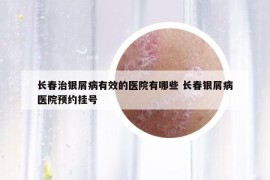 长春治银屑病有效的医院有哪些 长春银屑病医院预约挂号