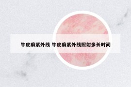 牛皮癣紫外线 牛皮癣紫外线照射多长时间