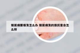 银屑病要爆发怎么办 银屑病发的很厉害会怎么样