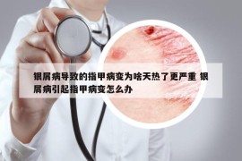 银屑病导致的指甲病变为啥天热了更严重 银屑病引起指甲病变怎么办