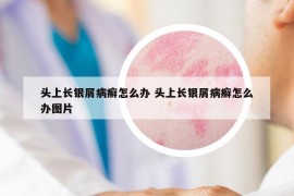 头上长银屑病癣怎么办 头上长银屑病癣怎么办图片