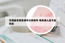 生殖器有银屑病可以同房吗 银屑病人能不能同房