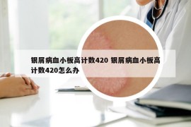 银屑病血小板高计数420 银屑病血小板高计数420怎么办