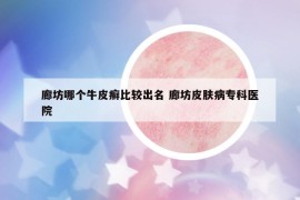 廊坊哪个牛皮癣比较出名 廊坊皮肤病专科医院