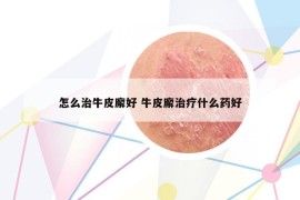 怎么治牛皮廨好 牛皮廨治疗什么药好