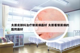 太原皮肤科治疗银屑病最好 太原看银屑病的医院最好