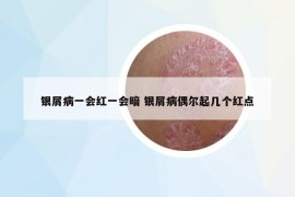 银屑病一会红一会暗 银屑病偶尔起几个红点