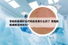 掌跖脓疱病好治疗吗应该用什么药了 掌跖脓疱病根治特效方?
