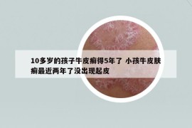 10多岁的孩子牛皮癣得5年了 小孩牛皮肤癣最近两年了没出现起皮