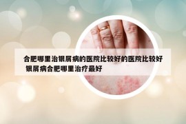 合肥哪里治银屑病的医院比较好的医院比较好 银屑病合肥哪里治疗最好