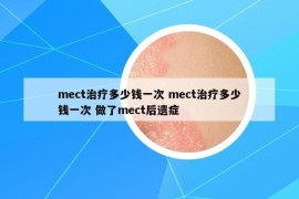 mect治疗多少钱一次 mect治疗多少钱一次 做了mect后遗症