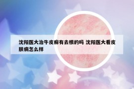 沈阳医大治牛皮癣有去根的吗 沈阳医大看皮肤病怎么样