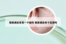 银屑病会单发一个痘吗 银屑病会单个出现吗