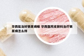 华西能治好银屑病嘛 华西医院皮肤科治疗银屑病怎么样