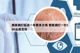银屑病打拓咨一年要多少钱 银屑病打一针100元就见效