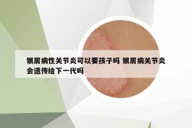 银屑病性关节炎可以要孩子吗 银屑病关节炎会遗传给下一代吗