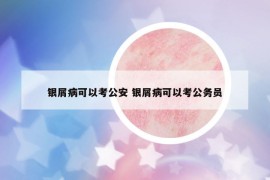 银屑病可以考公安 银屑病可以考公务员