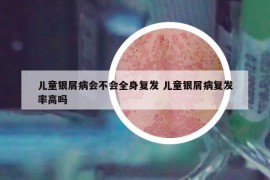 儿童银屑病会不会全身复发 儿童银屑病复发率高吗