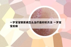 一岁宝宝银屑病怎么治疗最好的方法 一岁宝宝皮癣