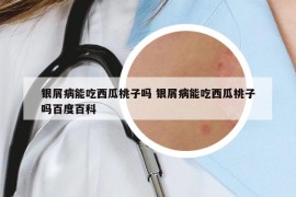 银屑病能吃西瓜桃子吗 银屑病能吃西瓜桃子吗百度百科