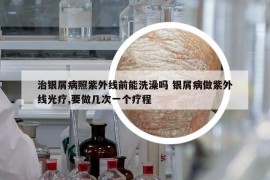治银屑病照紫外线前能洗澡吗 银屑病做紫外线光疗,要做几次一个疗程