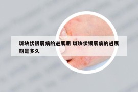 斑块状银屑病的进展期 斑块状银屑病的进展期是多久