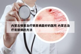 内蒙古哪里治疗银屑病最好的医院 内蒙古治疗皮肤病的方法