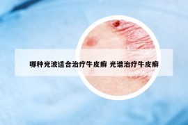 哪种光波适合治疗牛皮癣 光谱治疗牛皮癣