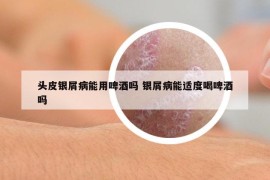 头皮银屑病能用啤酒吗 银屑病能适度喝啤酒吗
