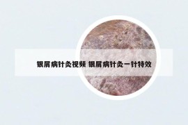 银屑病针灸视频 银屑病针灸一针特效